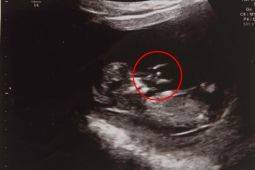На снимке эмбриона нашли ангела
