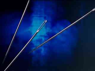 12-летний житель Павлодара с рождения жил с тремя иглами в теле