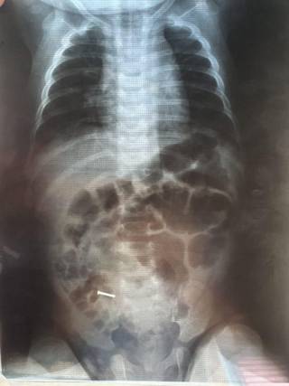 В Шымкенте четырехмесячный ребенок проглотил железный гвоздь