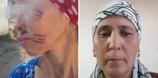 Золовка поставила невестке клеймо на лице – полиция разбирается в происшествии